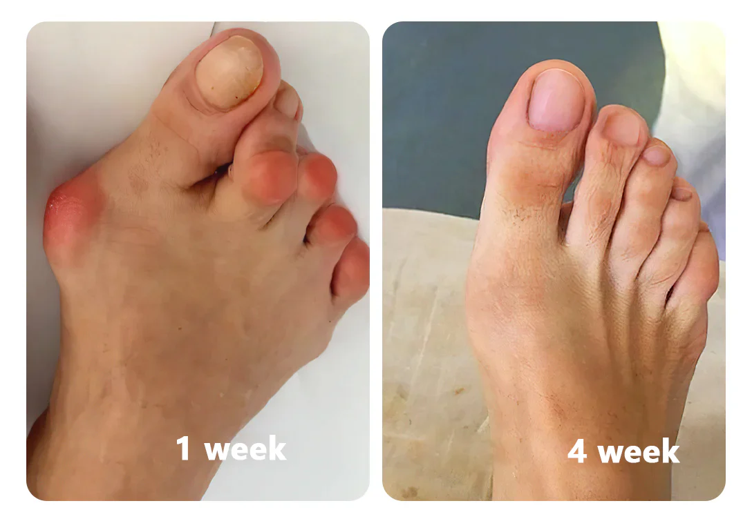 Artrosi ai piedi