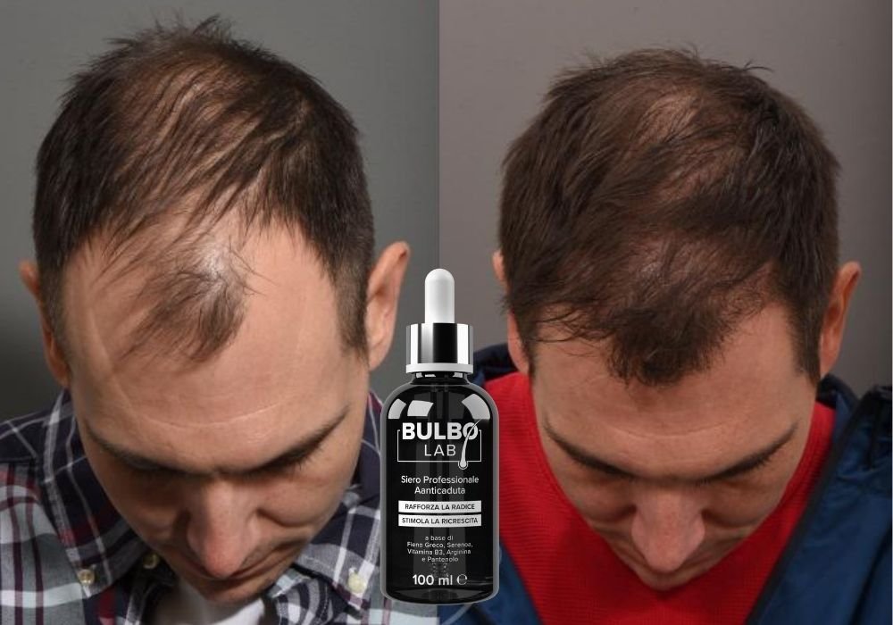 Alopecia androgenetica