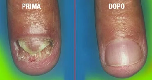 Micosi unghie mani uomo