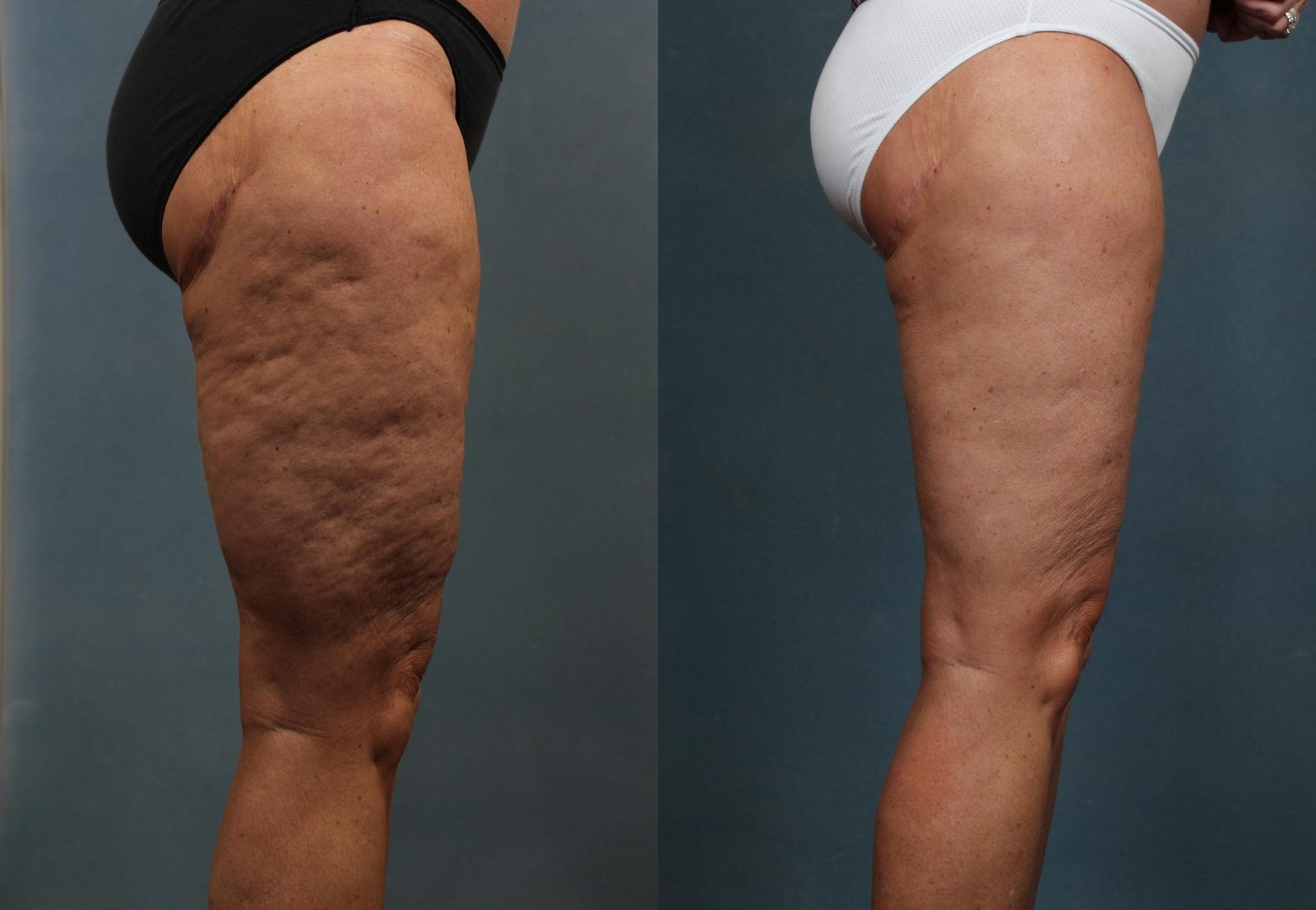 Cellulite e buccia d’arancia