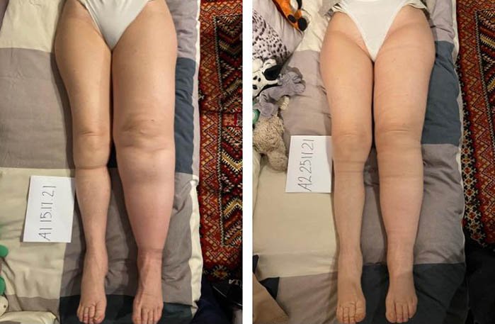 Gambe gonfie e ritenzione